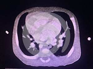 CT scan angiogram show dextrocardia the congenital heart disease photo