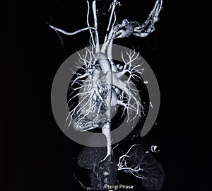 Ct scan angiogram (take photo from film x-ray) photo