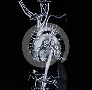 Ct scan angiogram (take photo from film x-ray) photo