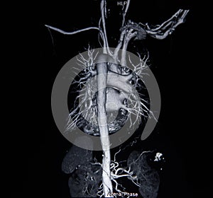 Ct scan angiogram (take photo from film x-ray)