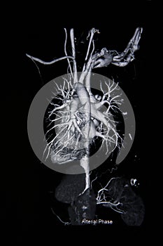 Ct scan angiogram (take photo from film x-ray)