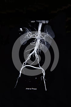 Ct scan angiogram (take photo from film x-ray) photo