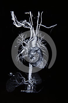 Ct scan angiogram (take photo from film x-ray) photo