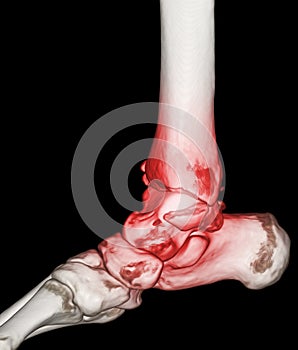 CT Scan ankle and foot or Computed Tomography of Ankle joint and Foot 3D Volume Rendering image showing fractured Tibia and fibula