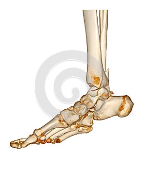 CT Scan ankle and foot or Computed Tomography of Ankle joint and Foot 3D Volume Rendering image showing fractured Tibia and fibula