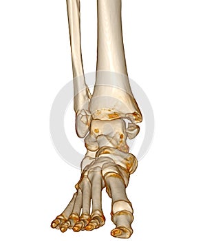 CT Scan ankle and foot or Computed Tomography of Ankle joint and Foot 3D Volume Rendering image showing fractured Tibia and fibula