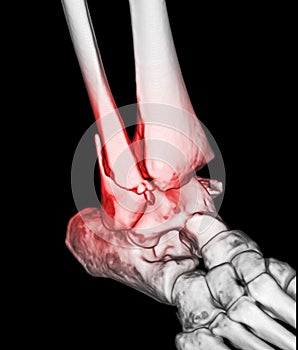 CT Scan ankle and foot or Computed Tomography of Ankle joint and Foot 3D Volume Rendering image showing fractured Tibia and fibula