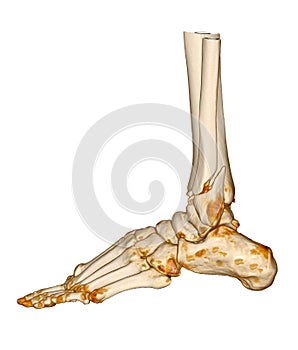 CT Scan ankle and foot or Computed Tomography of Ankle joint and Foot 3D Volume Rendering image showing fractured Tibia and fibula