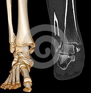 CT Scan ankle and foot or Computed Tomography of Ankle joint and Foot 3D Volume Rendering image showing fractured Tibia and fibula