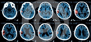 CT scan of the brain.