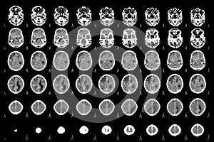 CT Scan Brain Axial views .to evaluate brain tumor. Glioblastoma, brain metastasis isodensity mass with an ill-defined margin and