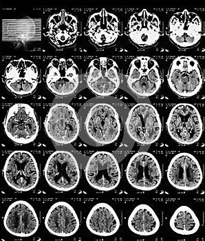 CT scan of brain with contrast media.