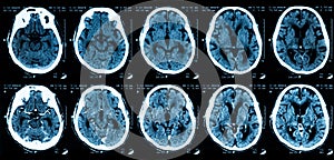 CT scan of brain, without and with contrast media.