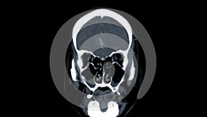 CT scan of the brain Coronal view  for diagnosis brain tumor,stroke diseases and vascular diseases