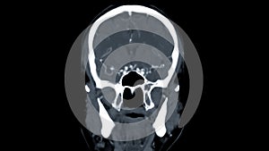 CT scan of the brain Coronal view  for diagnosis brain tumor,stroke diseases and vascular diseases