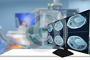 CT Scan brain Finding isodense mass with ill-defined margin and surrounding edema at the Left frontal lobe. Glioblastoma, brain