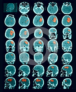 CT scan of the brain. Hemorrhagic stroke. photo