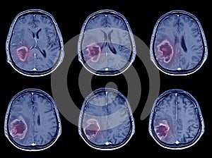 CT-Scan Brain Imaging for hemorrhagic stroke or Ischemic stroke