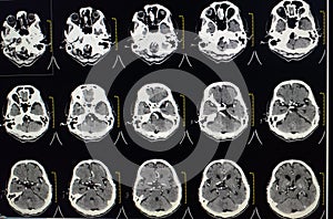 CT-SCAN BRAIN A MALE 76 YEAR OLD SHOWS BRAIN ATROPHY.