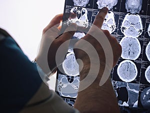 CT scan of the brain. MRI of the brain. Doctor, looking at the roentgenogram of a computer tomography on a negatoscope