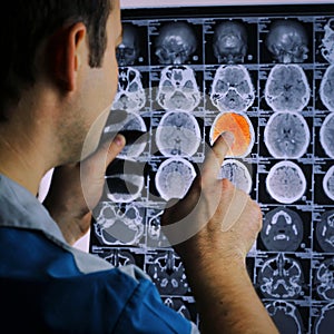 CT scan of the brain. MRI of the brain. ischemic stroke. Doctor, looking at the roentgenogram of a computer tomography on a negato