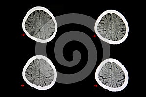 CT scan cerebral infarction photo