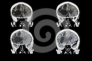 metastatic brain tumor photo
