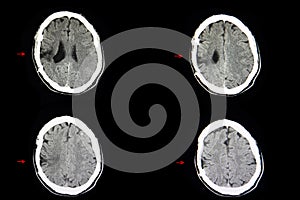 CT scan cerebro malacia photo