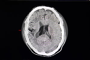 CT scan cerebro malacia photo