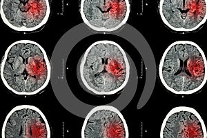 CT scan of brain with red area ( Imaging for hemorrhagic stroke or Ischemic stroke ( infarction ) concept )