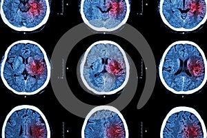 CT scan of brain with red area ( Imaging for hemorrhagic stroke or Ischemic stroke ( infarction ) concept )