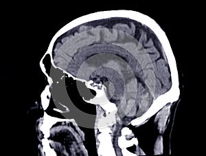 CT scan of the brain sagittal view  for diagnosis brain tumor,stroke diseases and vascular diseases