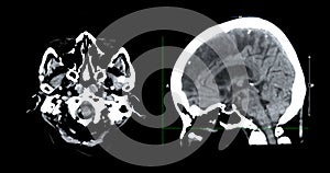 CT scan of the brain sagittal view  for diagnosis brain tumor,stroke diseases and vascular diseases