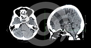 CT scan of the brain sagittal view  for diagnosis brain tumor,stroke diseases and vascular diseases