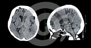 CT scan of the brain sagittal view  for diagnosis brain tumor,stroke diseases and vascular diseases