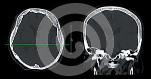 CT scan of the brain sagittal view  for diagnosis brain tumor,stroke diseases and vascular diseases