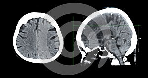 CT scan of the brain sagittal view  for diagnosis brain tumor,stroke diseases and vascular diseases