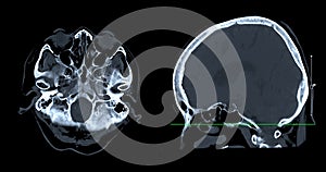 CT scan of the brain sagittal view  for diagnosis brain tumor,stroke diseases and vascular diseases