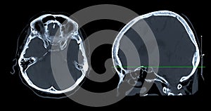 CT scan of the brain sagittal view  for diagnosis brain tumor,stroke diseases and vascular diseases