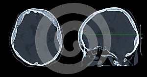 CT scan of the brain sagittal view  for diagnosis brain tumor,stroke diseases and vascular diseases