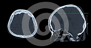 CT scan of the brain sagittal view  for diagnosis brain tumor,stroke diseases and vascular diseases