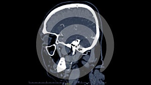 CT scan of the brain sagittal view for diagnosis brain tumor,stroke diseases and vascular diseases