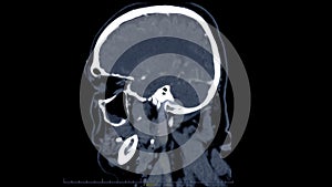 CT scan of the brain sagittal view for diagnosis brain tumor,stroke diseases and vascular diseases