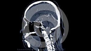 CT scan of the brain sagittal view for diagnosis brain tumor,stroke diseases and vascular diseases