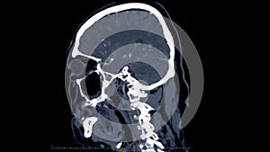 CT scan of the brain sagittal view for diagnosis brain tumor,stroke diseases and vascular diseases