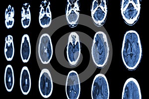 CT scan of brain show ischemic stroke and hemorrhagic stroke