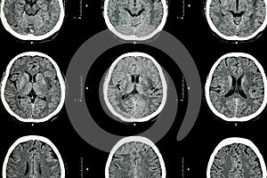 CT scan of brain show normal brain ( Neurological background )CT scan of brain show normal brain ( Neurological background )