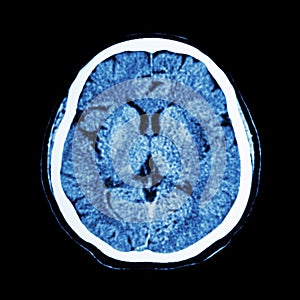 CT scan of brain : show normal human's brain ( CAT scan )