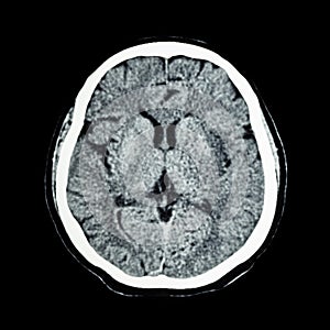 CT scan of brain : show normal human's brain ( CAT scan )