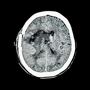 CT scan of brain : show old right basal ganglia hemorrhage with brain edema ( status post craniotomy ) ( Hemorrhagic stroke ) photo